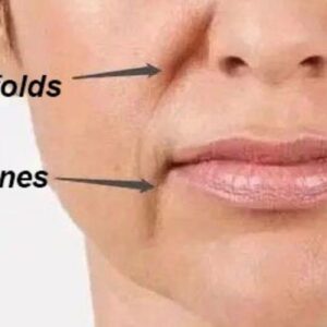Filler Marionette Lines (Lines from Mouth Corners Downward)