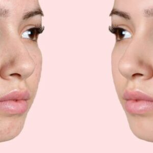 Filler Minor Facial Asymmetry Correction