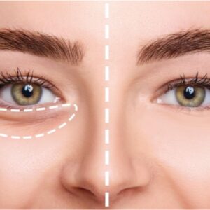 Under-Eye Filler
