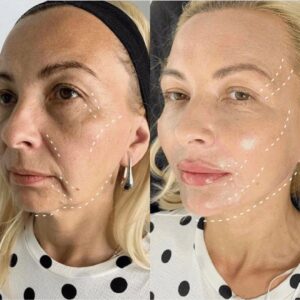 Botox Correction