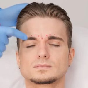Botox for Glabellar Frown Lines (11 Lines)