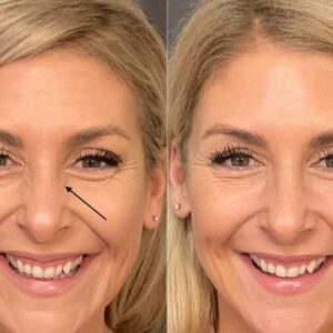 Botox for Nose