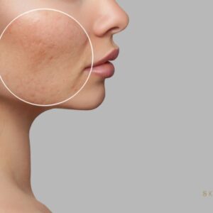 Filler Acne Scars & Skin Rejuvenation