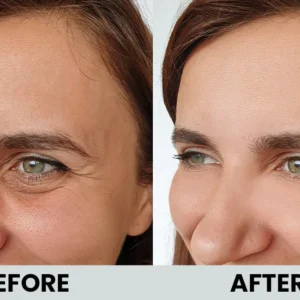 Botox for crows feet