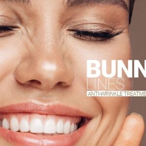 Botox for Bunny Lines Reduces Fine Lines on the Sides of the Nose When Smiling