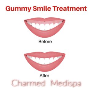BOTOX FOR GUMMY SMILE CORRECTION Upper Lip Relaxation to Reduce Gum Exposure