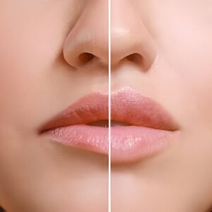 Botox for Lip Definition