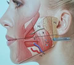 Botox jaw muscles (smiling and teeth grinding)