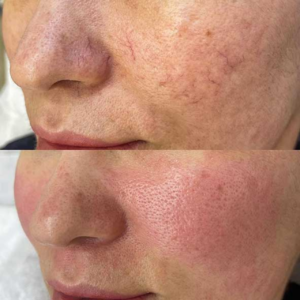 Laser Treatment for Facial Vascular Lesions