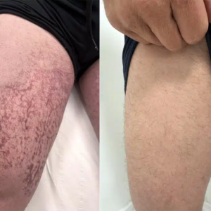 Laser Treatment for Leg Thread Veins