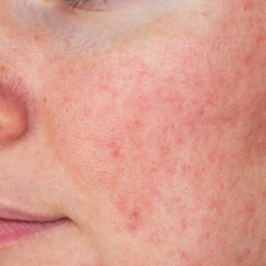Laser Treatment for Red Vascular Spots