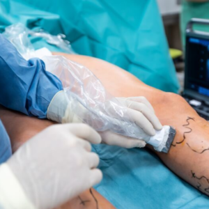 Laser Treatment for Small Varicose Veins