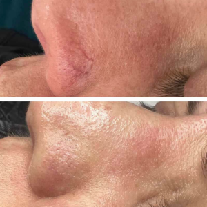 Laser Treatment for Vascular Nose Veins